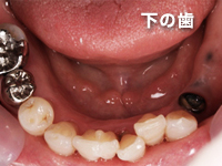 インプラント治療.1　下の歯