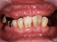 インプラント治療.5　上の歯[術前]