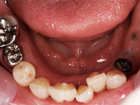 インプラント治療.5　下の歯[術前]