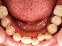 インプラント治療.5　下の歯[術後]